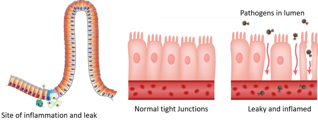 Examples of the GI tract showing the site of inflammation and leak as well as normal tight junctions and leaky and inflamed junctions